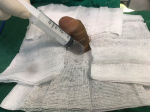 Tăng kích thước cậu nhỏ bằng tấm độn megaderm, đường mổ ở mu, khách hàng 35 tuổi, Hà Nội -  ca 118