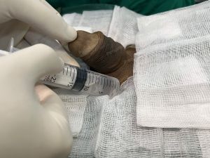 Động dương vật bằng mô da nhân tạo, đường mổ ở mu, khách hàng 43 tuổi, Lào Cai - ca 123