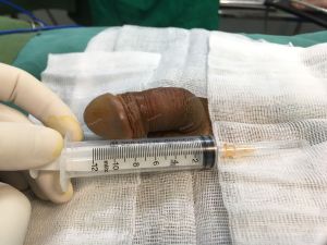 Độn dương vật bằng tấm độn megaderm, đường mổ ở mu, khách hàng 33 tuổi Hà Nội - ca 114