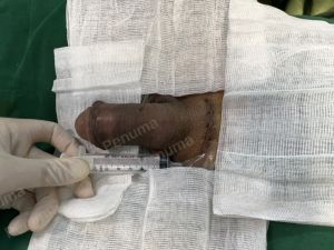 Độn dương vật bằng mô da nhân tạo, đường mổ ở mu, khách hàng 42 tuổi Ninh Bình - ca 110