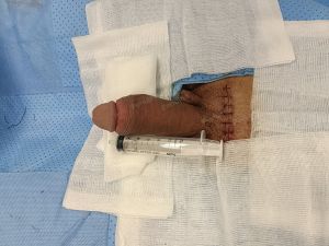 Độn dương vật bằng mô da nhân tạo, đường mổ ở mu, khách hàng 36 tuổi, HCM -  ca 121