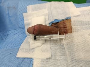 Độn dương vật bằng mô da nhân tạo, đường mổ ở mu, khách hàng 36 tuổi, HCM -  ca 121