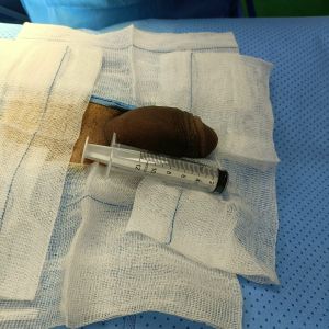 Tăng kích thước dương vật bằng mô da nhân tạo, đường mổ ở mu, khách hàng 46 tuổi Nha Trang - ca 91