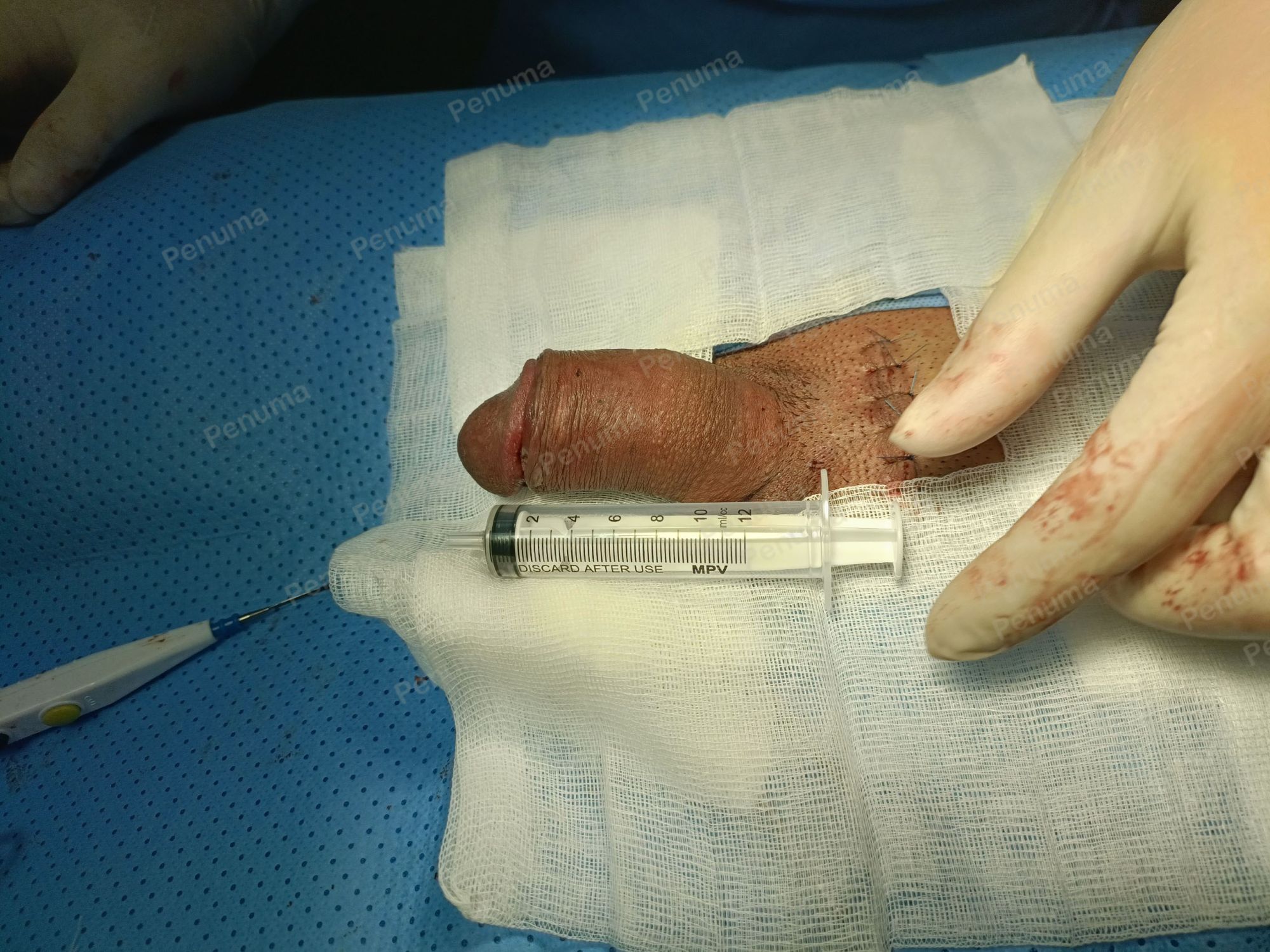 Tăng kích thước dương vật bằng mô da nhân tạo, đường mổ ở mu, khách hàng 34 tuổi HCM - ca 101