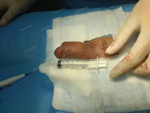 Tăng kích thước dương vật bằng mô da nhân tạo, đường mổ ở mu, khách hàng 34 tuổi HCM - ca 101