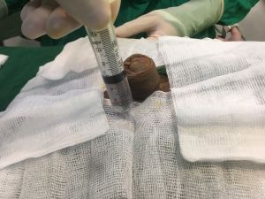 Độn dương vật bằng mô da nhân tạo, đường mổ ở mu, khách hàng 29 tuổi Hà Nội - ca 106