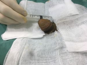 Tăng kích thước bằng mô da nhân tạo, đường mổ ở mu, khách hàng 35 tuổi Hà Nội - ca 109