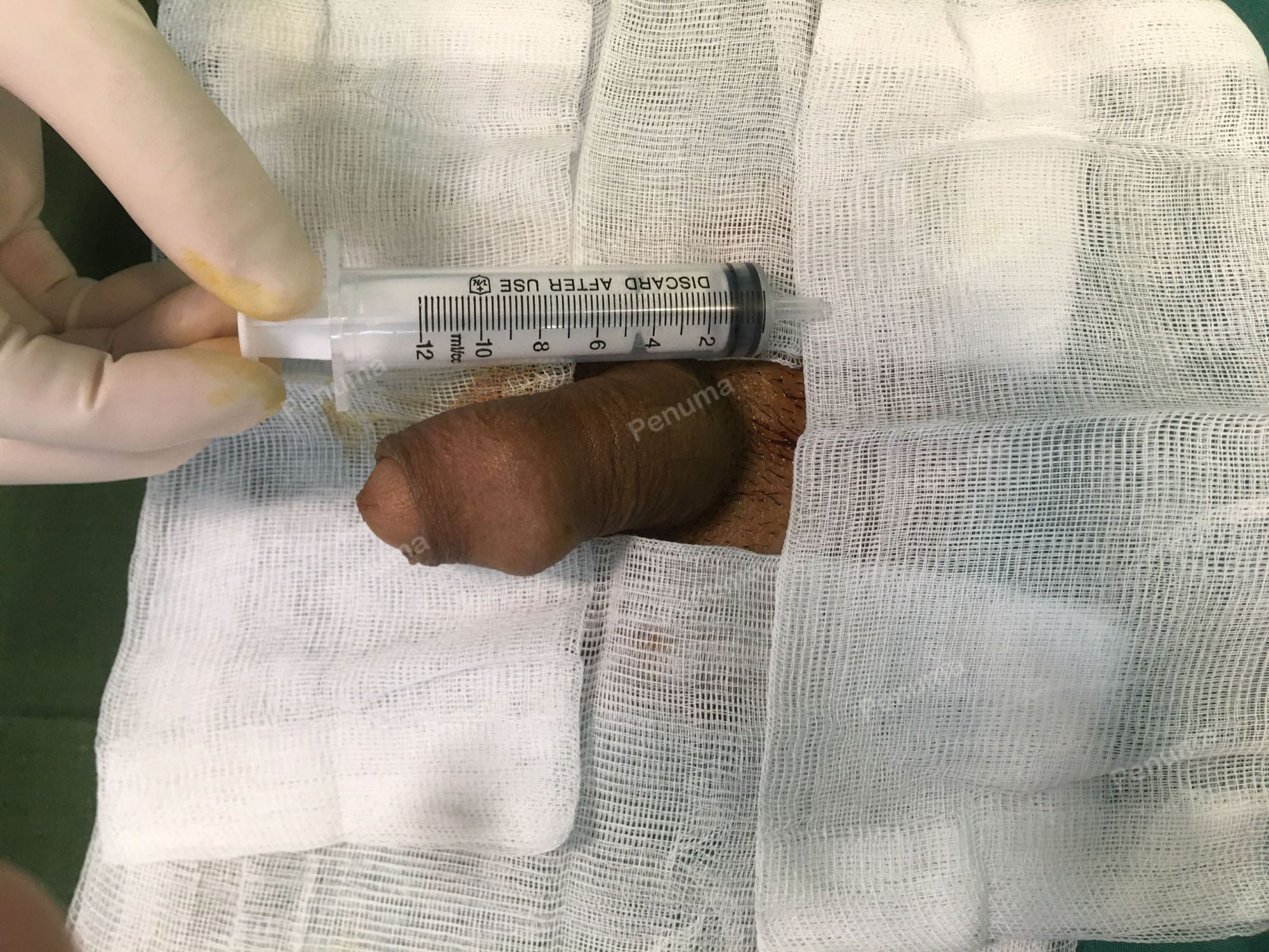 Độn dương vật bằng mô da nhân tạo, đường mổ ở mu, khách hàng 37 tuổi Lào Cai - ca 98