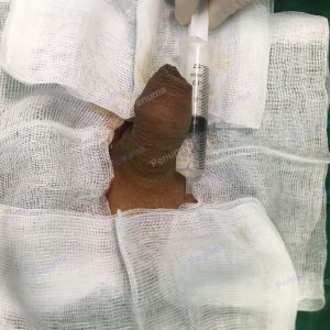 Độn dương vật bằng mô da nhân tạo, đường mổ ở mu, khách hàng 35 tuổi Quảng Ninh - ca 100