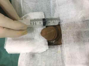 Tăng kích thước bằng mô da nhân tạo, đường mổ ở mu, khách hàng 35 tuổi Hà Nội - ca 109