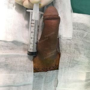 Độn dương vật bằng tấm độn megaderm, đường mổ ở mu, khách hàng 33 tuổi Hà Nội - ca 114