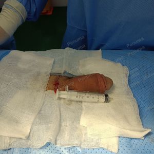 Tăng kích thước dương vật bằng tấm độn sinh học, đường mổ ở mu, khách hàng 33 tuổi HCM - ca 113