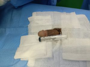 Độn dương vật bằng mô da nhân tạo, đường mổ ở mu, khách hàng 36 tuổi, HCM -  ca 121