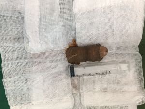 Tăng kích thước dương vật bằng mô da nhân tạo, đường mổ ở mu, khách hàng 38 tuổi Hà Nội- ca 89