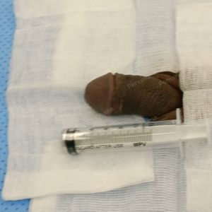 Tăng kích thước dương vật bằng mô da nhân tạo, đường mổ ở mu, khách hàng 34 tuổi HCM - ca 101