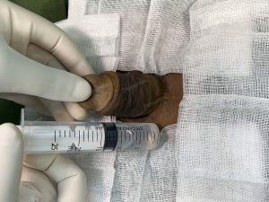 Động dương vật bằng mô da nhân tạo, đường mổ ở mu, khách hàng 43 tuổi, Lào Cai - ca 123