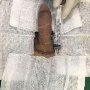 Tăng kích thước dương vật bằng mô da nhân tạo, đường mổ ở mu, khách hàng 38 tuổi Hà Nội- ca 89