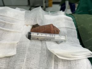 Tăng kích thước cậu nhỏ bằng tấm độn sinh học, đường mổ ở mu, khách hàng 42 tuổi, Thanh Hóa -  ca 120