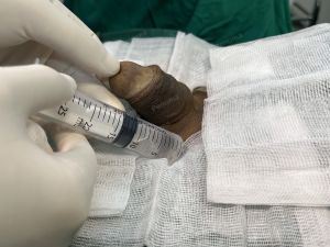 Động dương vật bằng mô da nhân tạo, đường mổ ở mu, khách hàng 43 tuổi, Lào Cai - ca 123