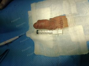 Tăng kích thước dương vật bằng mô da nhân tạo, đường mổ ở mu, khách hàng 34 tuổi HCM - ca 101