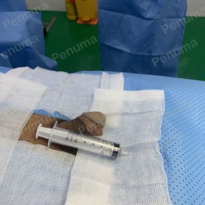 Tăng kích thước dương vật bằng tấm độn sinh học, đường mổ ở mu, khách hàng 33 tuổi HCM - ca 113