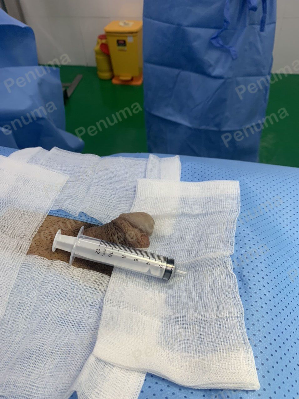 Tăng kích thước dương vật bằng tấm độn sinh học, đường mổ ở mu, khách hàng 33 tuổi HCM - ca 113