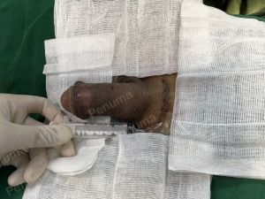 Độn dương vật bằng mô da nhân tạo, đường mổ ở mu, khách hàng 42 tuổi Ninh Bình - ca 110