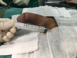 Độn dương vật bằng tấm độn megaderm, đường mổ ở mu, khách hàng 33 tuổi Hà Nội - ca 114