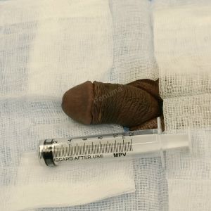 Tăng kích thước dương vật bằng mô da nhân tạo, đường mổ ở mu, khách hàng 34 tuổi HCM - ca 101