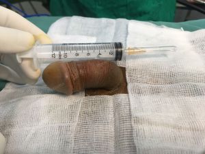 Độn dương vật bằng tấm độn megaderm, đường mổ ở mu, khách hàng 33 tuổi Hà Nội - ca 114