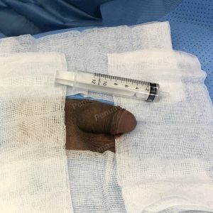 Tăng kích thước dương vật bằng mô da nhân tạo, đường mổ ở mu, khách hàng 30 tuổi An Giang - ca 111