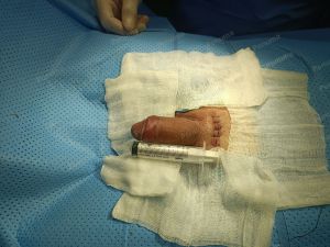 Tăng kích thước dương vật bằng mô da nhân tạo, đường mổ ở mu, khách hàng 30 tuổi An Giang - ca 111