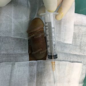 Độn dương vật bằng tấm độn megaderm, đường mổ ở mu, khách hàng 33 tuổi Hà Nội - ca 114