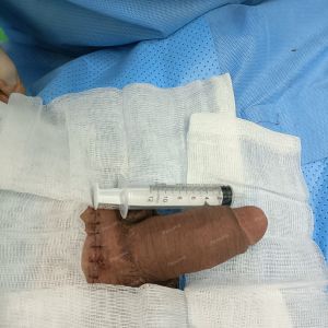 Độn dương vật bằng mô da nhân tạo, đường mổ ở mu, khách hàng 38 tuổi Bình Dương - ca 102