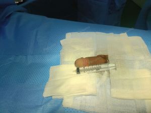 Độn dương vật bằng mô da nhân tạo, đường mổ ở mu, khách hàng 36 tuổi, HCM -  ca 121