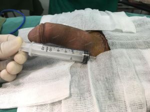 Độn dương vật bằng tấm độn megaderm, đường mổ ở mu, khách hàng 33 tuổi Hà Nội - ca 114