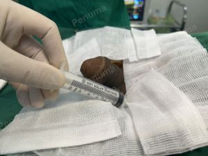 Độn dương vật bằng mô da nhân tạo, đường mổ ở mu, khách hàng 42 tuổi Ninh Bình - ca 110