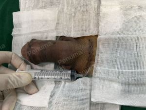 Độn dương vật bằng mô da nhân tạo, đường mổ ở mu, khách hàng 42 tuổi Ninh Bình - ca 110