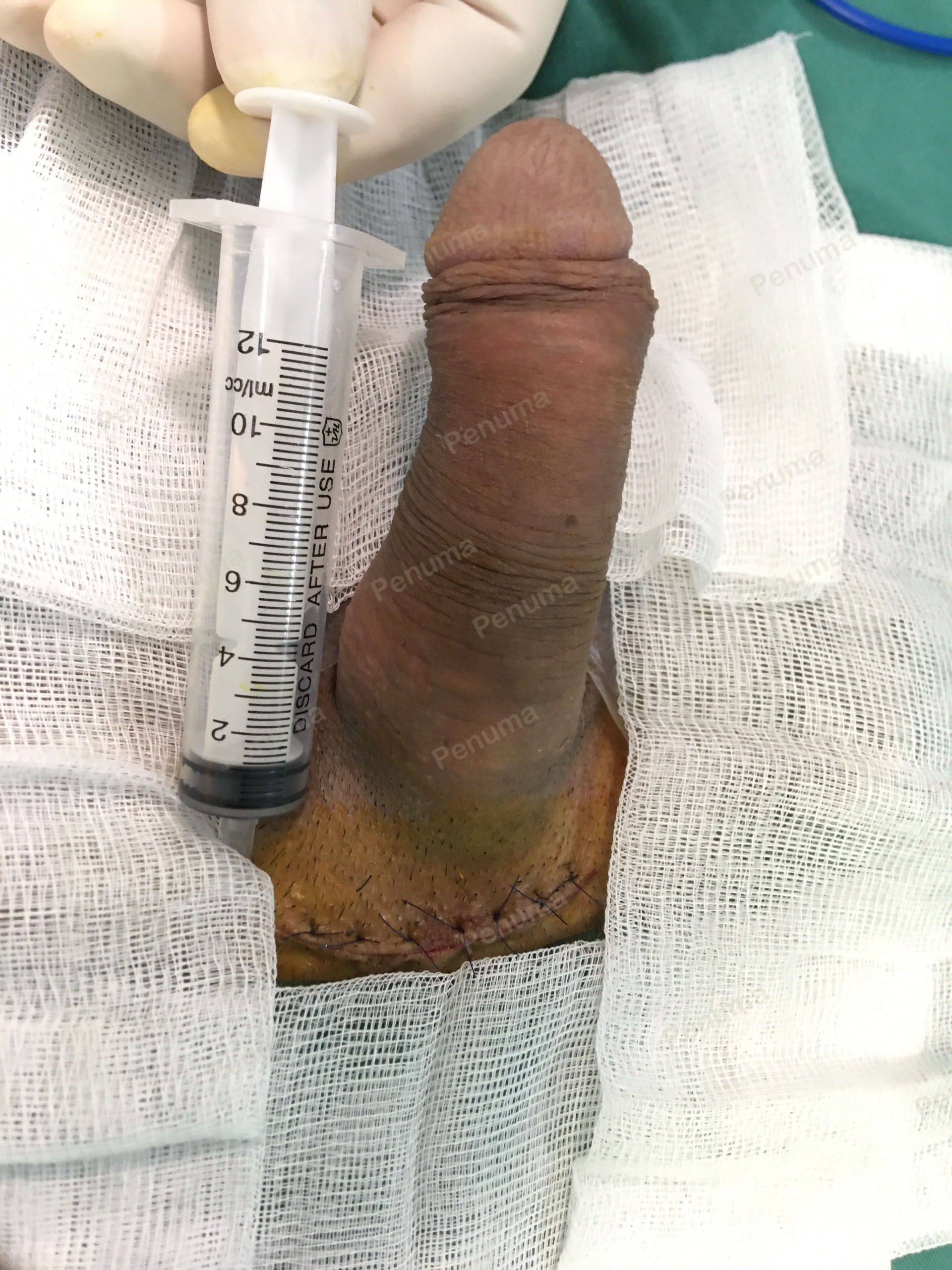 Độn dương vật bằng tấm độn megaderm, đường mổ ở mu, khách hàng 33 tuổi Hà Nội - ca 114