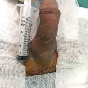 Độn dương vật bằng tấm độn megaderm, đường mổ ở mu, khách hàng 33 tuổi Hà Nội - ca 114