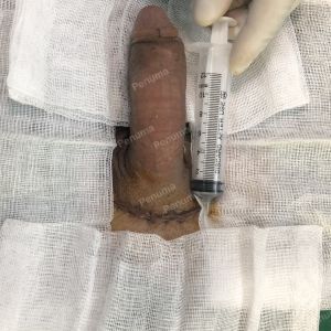Tăng kích thước dương vật bằng mô da nhân tạo, đường mổ ở mu, khách hàng 38 tuổi Hà Nội- ca 89