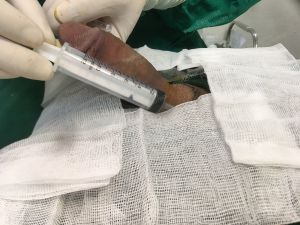 Tăng kích thước cậu nhỏ bằng tấm độn megaderm, đường mổ ở mu, khách hàng 35 tuổi, Hà Nội -  ca 118