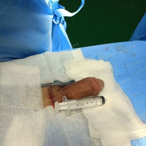 Tăng kích thước dương vật bằng tấm độn sinh học, đường mổ ở mu, khách hàng 33 tuổi HCM - ca 113