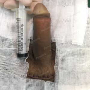 Độn dương vật bằng mô da nhân tạo, đường mổ ở mu, khách hàng 29 tuổi Hà Nội - ca 106
