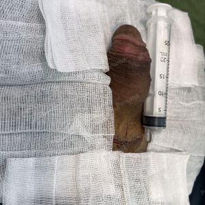 Động dương vật bằng mô da nhân tạo, đường mổ ở mu, khách hàng 43 tuổi, Lào Cai - ca 123