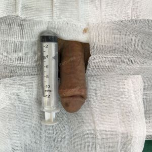 Tăng kích thước cậu nhỏ bằng tấm độn sinh học, đường mổ ở mu, khách hàng 42 tuổi, Thanh Hóa -  ca 120