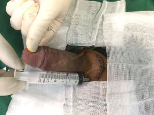 Tăng kích thước cậu nhỏ bằng tấm độn megaderm, đường mổ ở mu, khách hàng 35 tuổi, Hà Nội -  ca 118