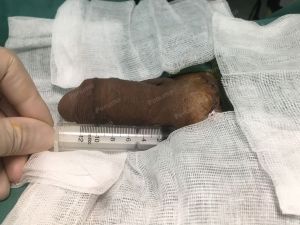 Tăng kích thước bằng mô da nhân tạo, đường mổ ở mu, khách hàng 35 tuổi Hà Nội - ca 109