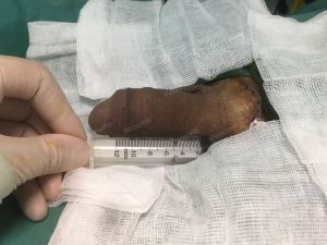 Tăng kích thước bằng mô da nhân tạo, đường mổ ở mu, khách hàng 35 tuổi Hà Nội - ca 109