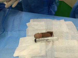 Độn dương vật bằng mô da nhân tạo, đường mổ ở mu, khách hàng 36 tuổi, HCM -  ca 121